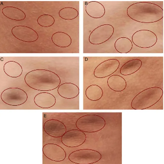 Figure 5. Scale for evaluating cellulite dimples, in which a dimple is an isolated circular or oval-shaped depression on the surface of the skin