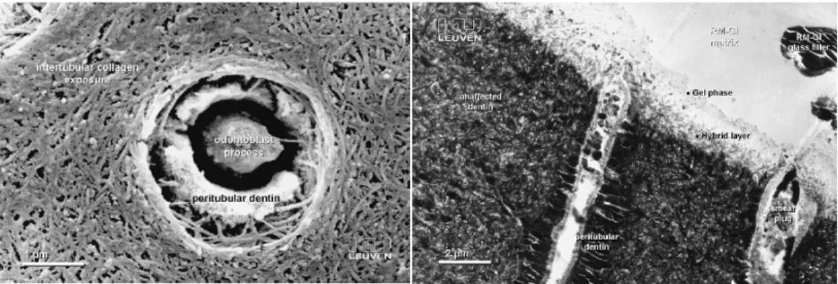 Figure 3: Adhesion of RMGI material to dentin. A) The effect of a polyacrylic acid 