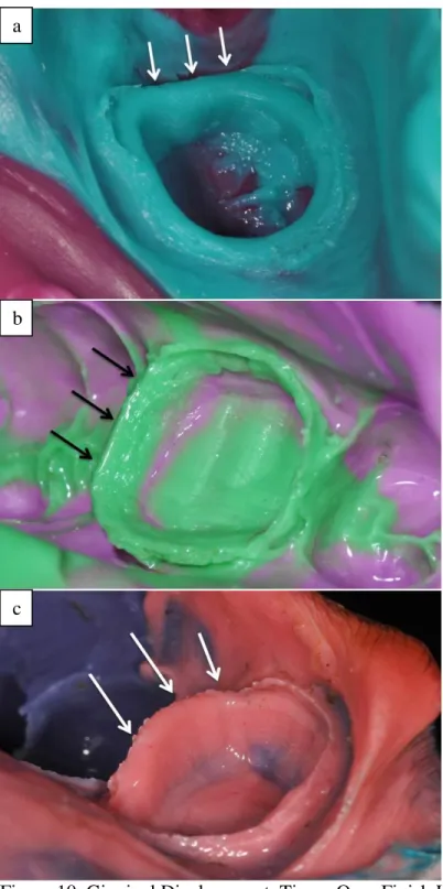 Figure 10. Gingival Displacement, Tissue Over Finish Line  Arrows indicate site of error 