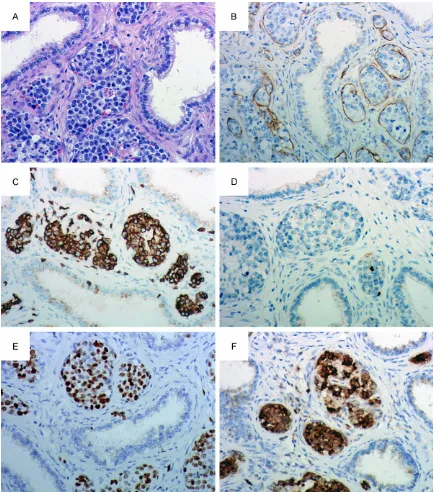 Figure 2. Histology and immunohistochemistry. (A) Small vessels of epididymis are filled with large atypical cells (H.E