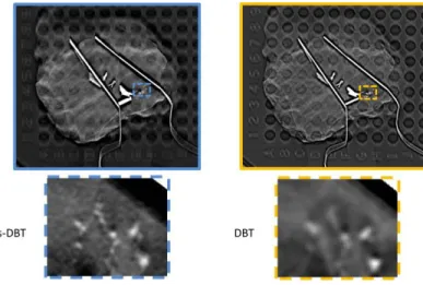 Figure 2.7 Comparison of the reconstructed images from s-DBT and DBT in human specimen study