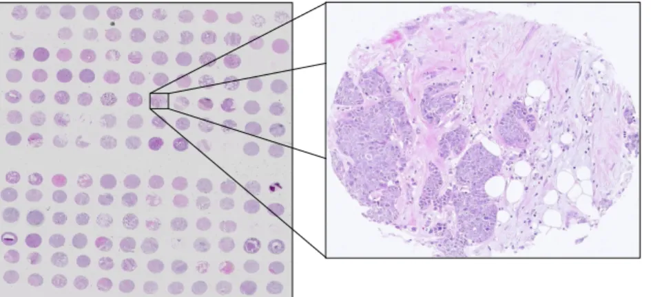 Figure 1.1: Example of a tissue microarray with a single core magnified.