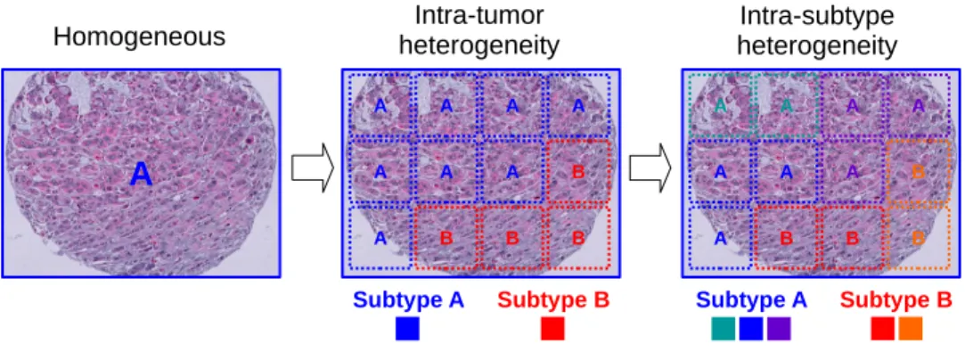 Figure 3.1: The proposed model handles intra-tumor heterogeneity by applying MI learning to multiple regions of an image using a feature set than can capture intra-subtype heterogeneity.
