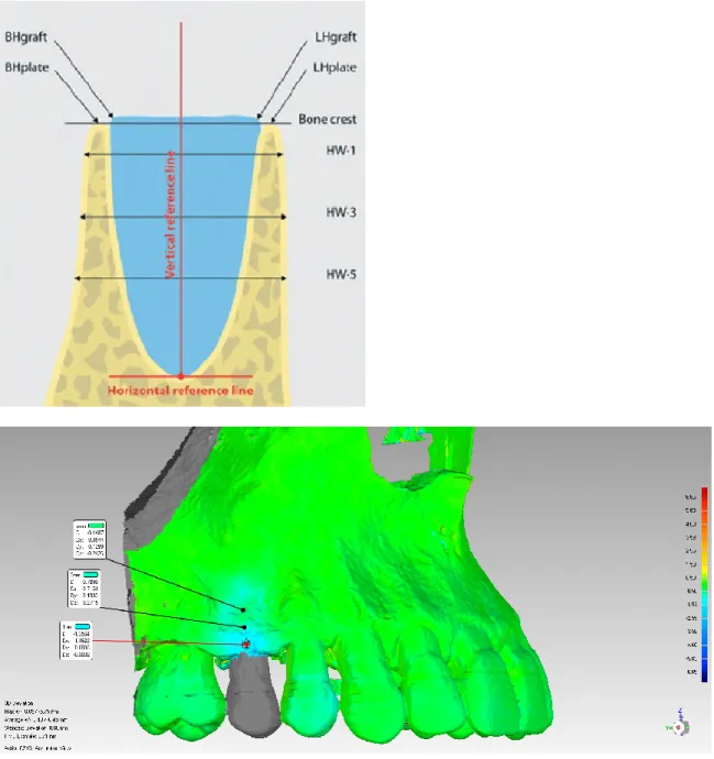 Figure 1: CBCT slice section. HW-1 (at -1mm), HW-3 (at -3mm), and HW-5 (at -5mm)  represent measurements performed at 3 levels below the bone crest 