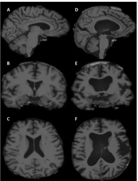 Figure 3.3: Subject with global atrophy whose data was discarded from  imaging analyses