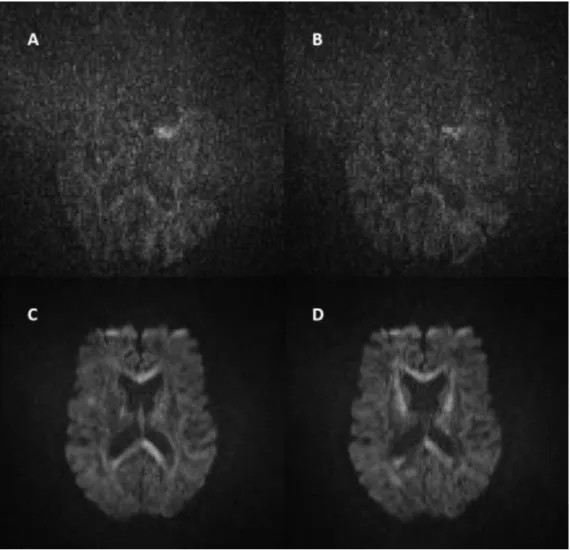 Figure 3.4: Raw diffusion images from a subject with poor signal-to-noise. A-B) discarded  b=2000 images from subject #5; C-D) high quality b=2000 images from subject #36