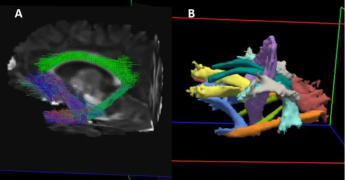 Figure 3.6: Example of reconstructed white matter pathways in TRACULA. A) Streamlines for the left uncinate  fasciculus (blue), left cingulum – cingulate gyrus ending (green, center), and cingulum – angular bundle (teal, bottom  right)