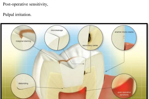 Figure 1.2: Potential Clinical Complication Due to Polymerization Shrinkage 