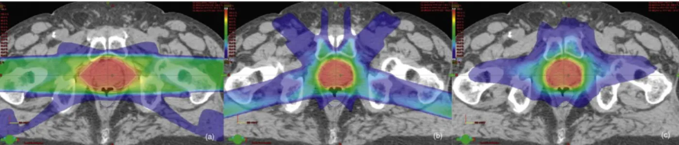 Fig. 2.1. Comparison of Dose Distribution for 3D-CRT, IMRT, and VMAT. The images represent the dose  distribution at the same axial slice of a patient receiving prostate only therapy utilizing (left) 3D-CRT, (middle)  static beam IMRT, and (right) VMAT