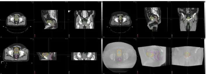 Fig. 3.2. DIR Profile Propagated Contours against Manual Delineation. Top left: Planning CT for a CTOR patient  with delineations for the bladder (yellow) and rectum (brown) in the axial (left), sagittal (center), and coronal (right)  planes