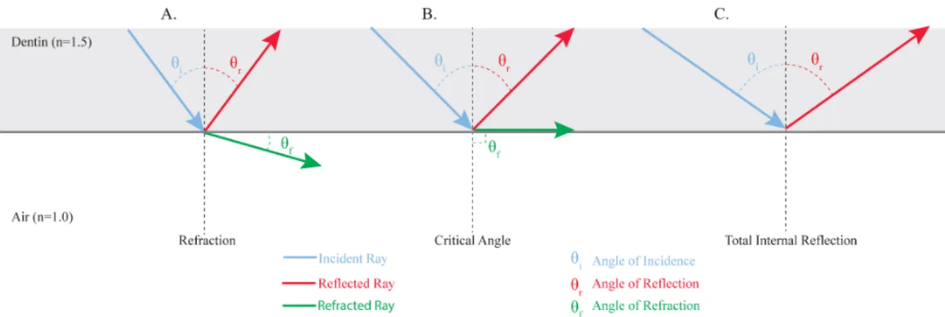 Figure 1: A. Light at fracture line with incident angle less than the critical angle resulting in  reflected ray returning through dentin and refracted ray continuing through crack