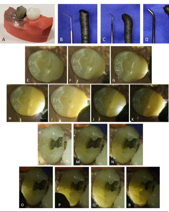 Figure 2: A. Sample tooth mounted for evaluation. B. Q-Optics Microscopic  Diagnostic Probe (QM)