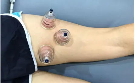 Figure 4 :  Cupping Application.  For application, cups were centered over the previously made marks  (Figure 3) and 2 pumps of suction were applied