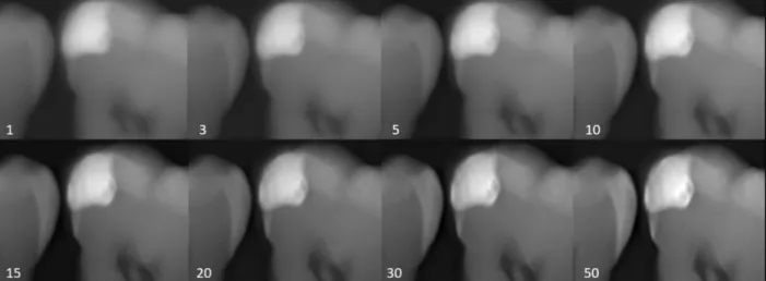 Figure 3. Pilot study image comparing various numbers of iterative reconstructions. A very subtle  incipient lesion located at the gingival margin