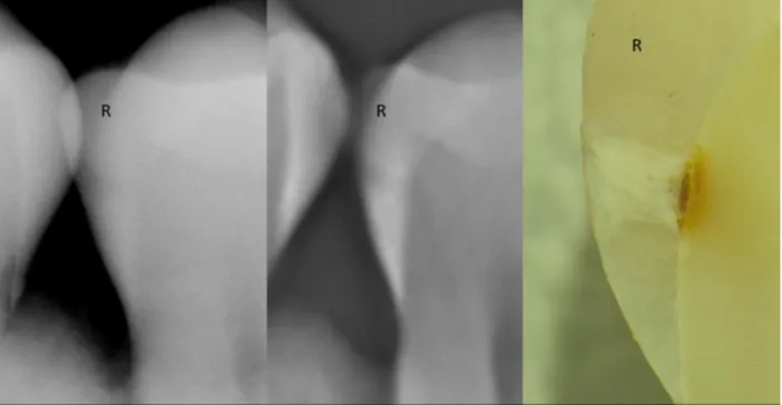Figure 5. Carious lesion extending to the DEJ.  Left, conventional intraoral bitewing