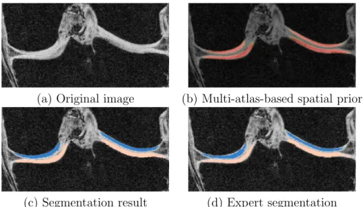 Figure 4.5: Cartilage segmentation of one example slice in coronal view. Only joint region is shown