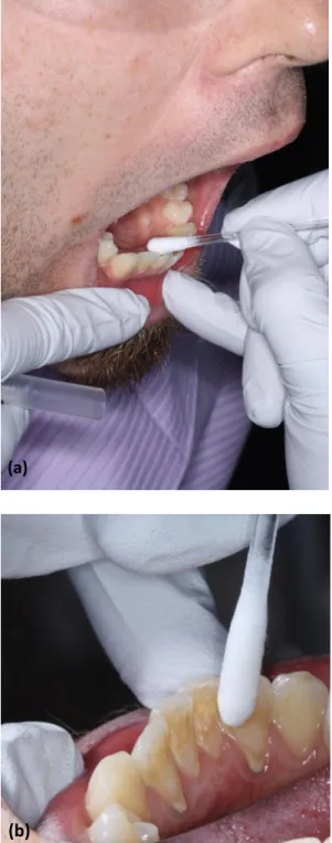 Fig. 5.  Plaque sample collection with CariScreen swabs from lingual surface of  mandibular anterior teeth (a and b)