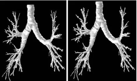 Figure 4. Computerized-tomography-based, three-dimensional images of airway lumen. 