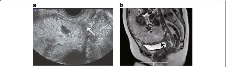 Fig. 1 Images for assessment of placenta accreta spectrum.Magnetic resonance imaging (MRI) at gestational week 31 revealed total placenta previa, and the placenta was located mainly on the anteriorside