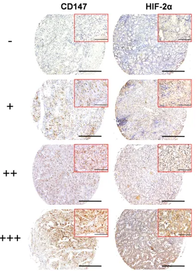 Figure 1. Representative immunohistochemical sta- ining of CD147 and HIF-2α in tissue microarrays of localized ccRCC