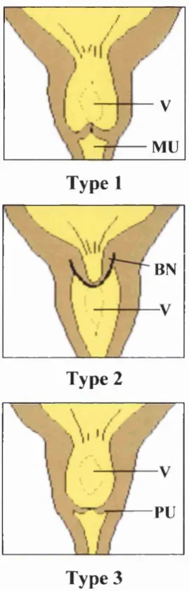 Figure 2. Posterior urethral valves classification