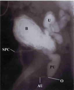 Figure 4. M icturating cystourethrogram of a boy with 