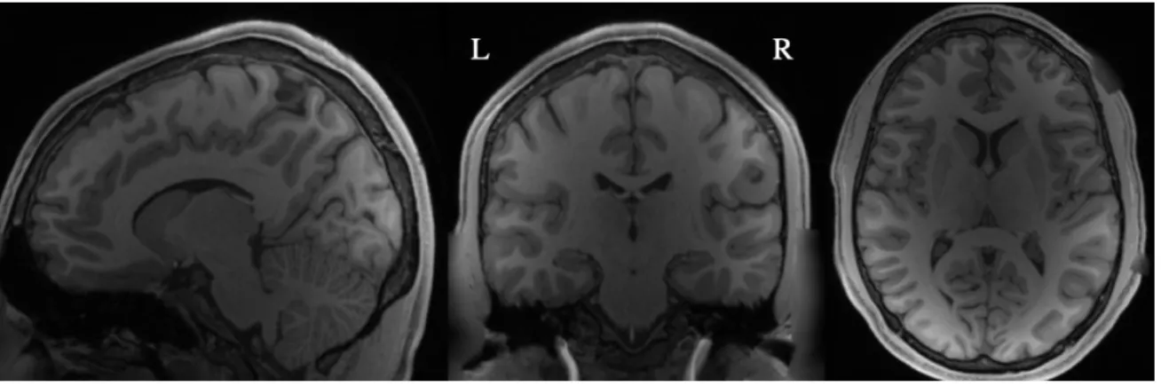 Figure 1: Example T1-weighted anatomical MR image for subject 1 from different view angles.