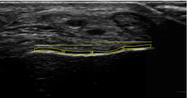 Figure III. Example of Talar Cartilage Ultrasound Image Analysis. 