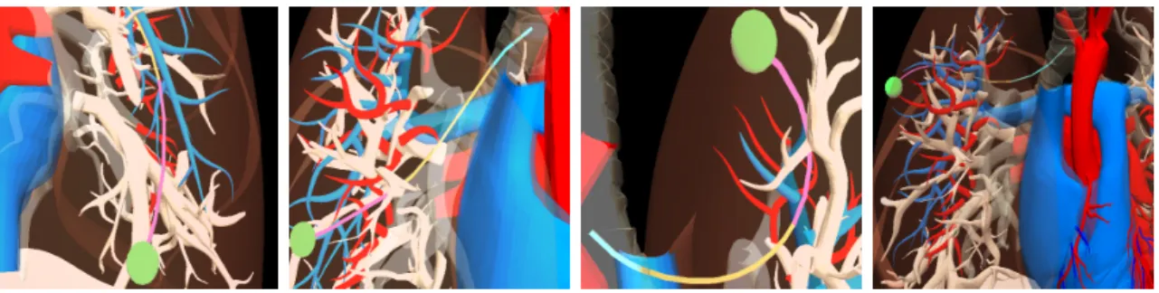 Figure 1.1: A simulated concentric tube robot operating under 4 different designs reaching clinical goal regions within the lung