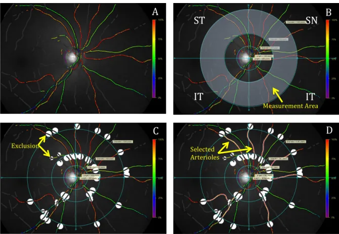 Figure	  2.	  Ring	  method	  analysis	  of	  retinal	  oximetry	  images.	  (A)	  Image	  when	  opened	  with	  Oxymap	   software.	  (B)	  Quadrants	  and	  circle	  outlines	  in	  place.	  (C)	  Exclusionary	  areas	  mapped.