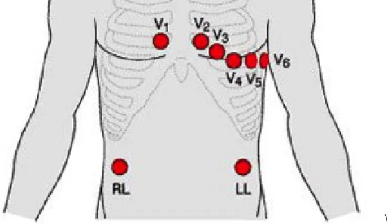 Figure 1: EKG Electrode Placement