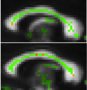 Figure 2: Sagittal view of results of DAB-TBSS  atlas  upon  a  10%  variation  in  the  principal  eigenvalue  between  the  two  groups  tested