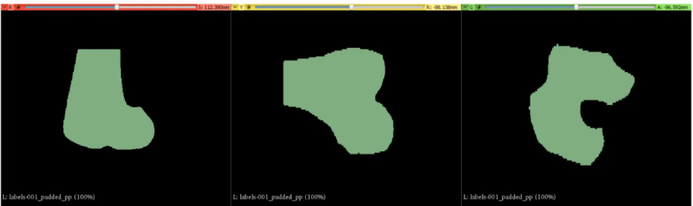 Figure 3: One of the three Femur volumes visualized in 3D Slicer [11] Volume Module 