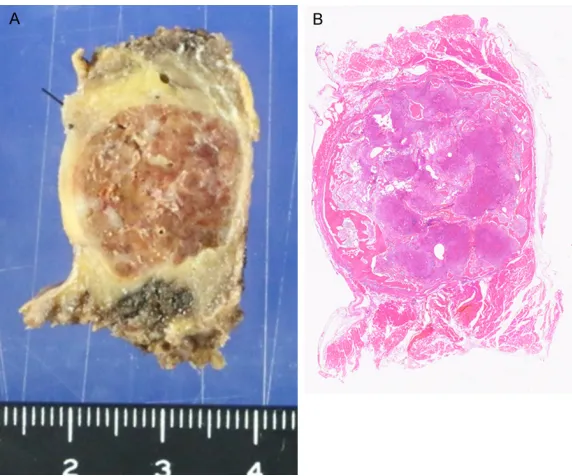 Figure 1. (A) A plain radiograph showing the bone tumor with ballooning on the right third rib