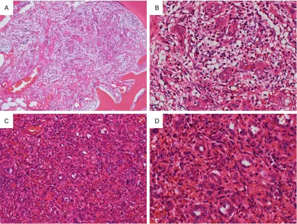 Figure 3. (A, B) Within the tumor, a slightly hypocellular area (A) composed of rather large-sized vessels and cellular areas (B) are noted; however, the latter is rather prominent