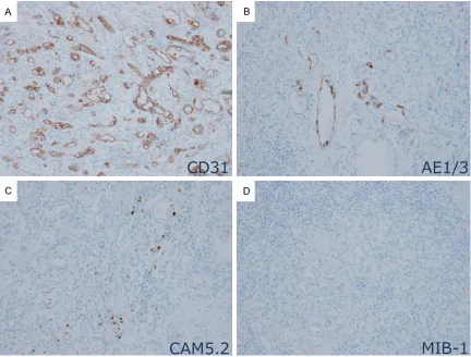 Figure 4. (D) Immunohistochemically, tumor cells were diffusely positive for CD31 (A) and were focally positive for AE1/AE3 (B), but were negative for CAM5.2 (C)