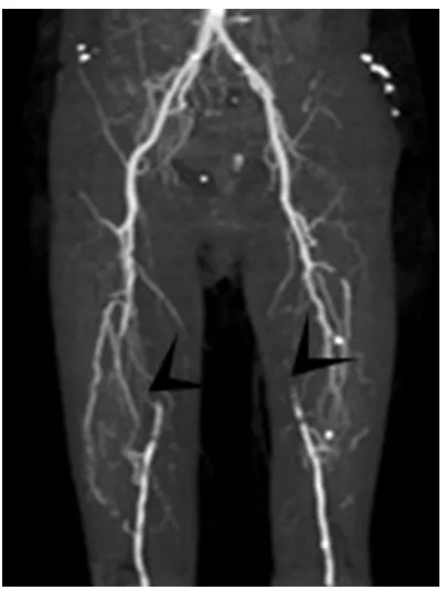 Figure 1. CT angiography of the lower limbs revealed an incomplete occlusion of both femoral arteries.