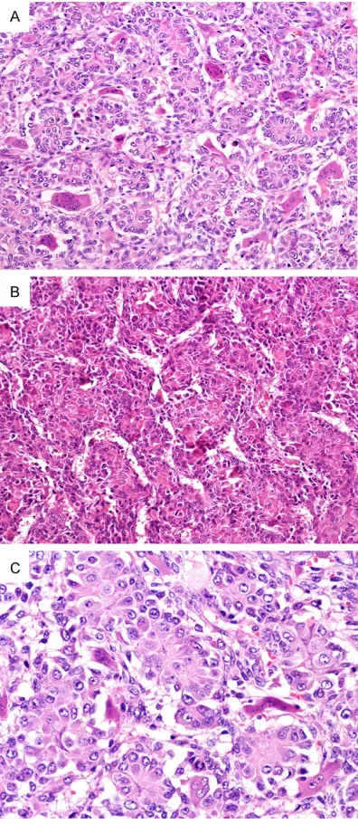 Figure 2. Histological features of epithelioid osteo-sarcoma of the femur. A. Osteosarcoma with ro-sette-like structures showing a small multinodular growth pattern with osteoid deposits in the center