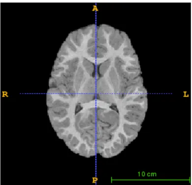 Figure 8. Output after Skull Stripping and Reference Alignment 