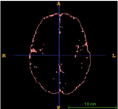 Figure 10. Preserved EA-CSF after the Ventricle Mask Removal 