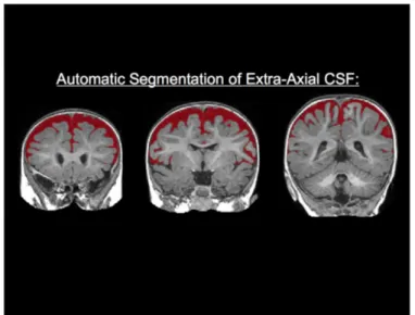 Figure 1. Automatic Segmentation of EA-CSF; Mark Shen; March 2017 