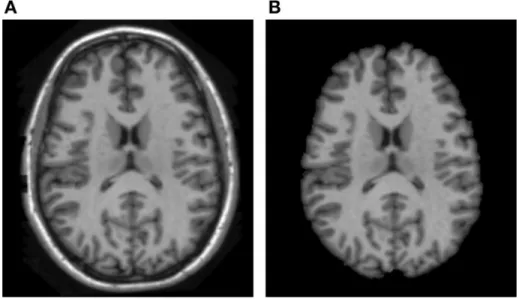 Figure 4. ABC based brain skull-stripping result. (A) the brain tissue in original MRI scan,   (B) the skull-stripped brain; Jiahui Wang; March, 2014 