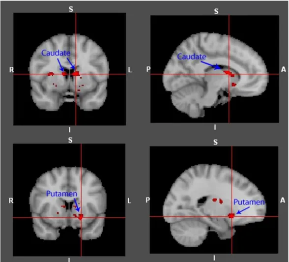 Figure 2. Visual representations of brain regions significantly less activated by the ASD group  relative to the control group during Face Loss anticipation