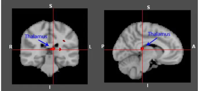 Figure 3. Visual representations of brain region significantly less activated by the ASD group  relative to the control group during Money Loss outcome