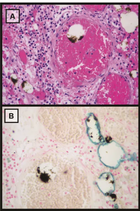 Figure 7 Microscopic analysis (25×) of tumor tissue stained with hematoxylin-eosin and Perls’ Prussian blue