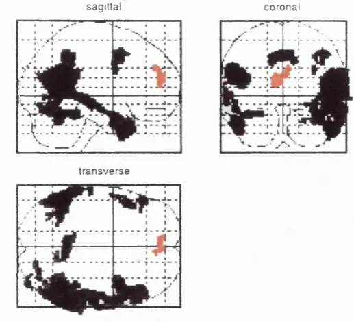 Figure 4.2. Brodmann ’s areas activated by musical performance (coloured spots centre on voxels 