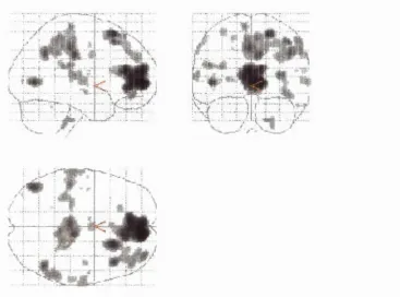 Figure 5.3. 'Glass brain ’ views o f activations during the role-to-control switch contrasted with role-play (RC-NR)