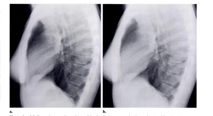 Figure 9. (a) “Proper” gray-scale rendition of the detail of a computed radiograph printed by a laser image re- re-corder defined jointly by the manufacturers of the computed radiography system and the printer system