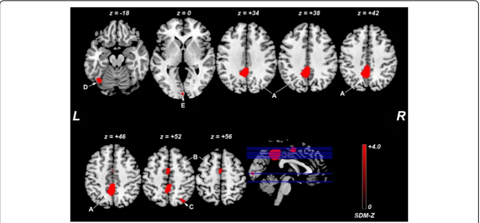 Fig. 3 Regions with ReHo heterogeneity across studies. Abbreviations: SDM, Seed-based d Mapping; L, left; R, right; a, bilateral posterior cingulatecortex (extending to the precuneus); b, left supplementary motor area, c, right superior parietal lobule (ex