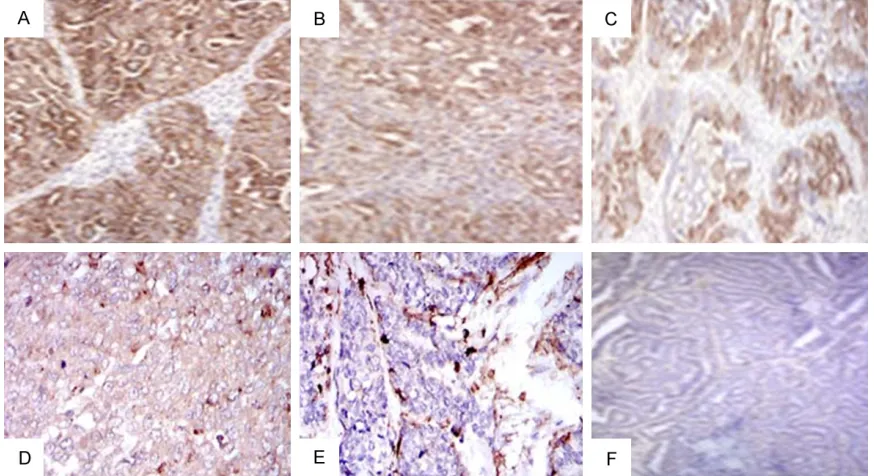 Figure 4. CD133 immunohistochemical staining of ovarian epithelial cancer. Based on the a positive intensity score (PI) of the cancer cells, (A) (poorly differentiated serous carcinoma) and (B) (poorly differentiated endometrioid carcinoma) represent the h